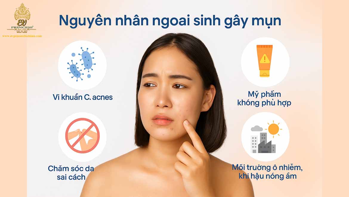 nguyen nhan chu yeu gay ra mun