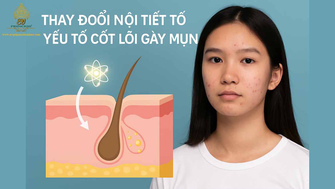 nguyen nhan noi mun o tuoi day thi